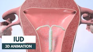 How does an IUD work  3D animation [upl. by Aleiram]