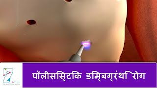 पॉलीसिस्टिक डिम्बग्रंथि रोग  Polycystic Ovarian Disease  Hindi [upl. by Eahsram615]