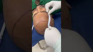 Hair Transplant Dhaka Bangladesh  2000 grafts Hair Transplant Bangladesh hairtransplantbangladesh [upl. by Aitercul]