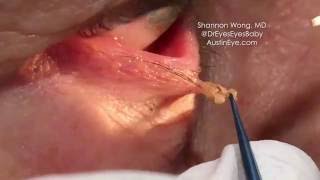 Excision of eyelid papilloma 91216 Shannon Wong MD [upl. by Nedap]