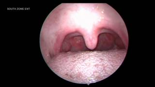 ATROPHIC TONSILS WITH GRANULAR PHARYNGITIS [upl. by Cimbura]