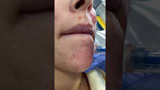 Dermapen 4 Microneedling SLOWMO  DRMEDISPA [upl. by Asirrac917]