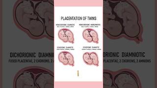 4 Types of twins medically Twin pregnancies pregnant youtubeshorts twins September 4 2024 [upl. by Serge92]