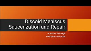 Discoid Meniscus Saucerization and Repair [upl. by Wu]