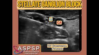 Ultrasound Guided Stellate Ganglion Block [upl. by Htebazileyram482]