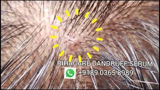 Cure sores dandruff scalp  9189 0365 8989 [upl. by Anette]