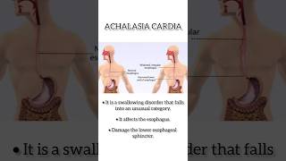 Achalasia Cardia I Treatment for Achalasia cardia in Delhi [upl. by Elinor75]