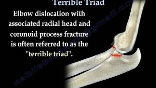 Elbow Fracture Dislocation Terrible Triad  Everything You Need To Know  Dr Nabil Ebraheim [upl. by Rudy339]