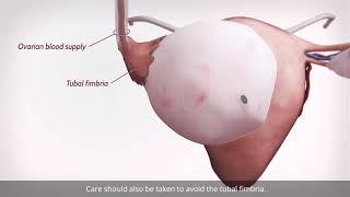 Laparoscopic ovarian cystectomy [upl. by Luy]