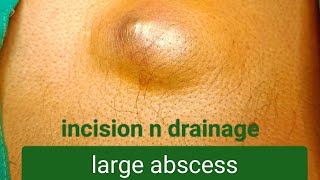 large abscess  incision n drainage dr youtube doctor [upl. by Yanrahc]