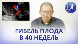 Антенатальная гибель плода в 40 недель covid обтурирующий тромбоз сосудов пуповины Что делать [upl. by Lanford]