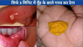 3 मिनिट मे मुंह और जीभ के छाले ठीक करने के लिए घरेलु उपाय  How To Get Rid Of Mouth and Tongue Ulcer [upl. by Ecnerat429]