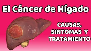 CÁNCER DE HÍGADO Causas signos y síntomas diagnóstico y tratamiento [upl. by Irving]