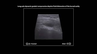 Subacromialsubdeltoid bursitis on shoulder ultrasound [upl. by Aerda]