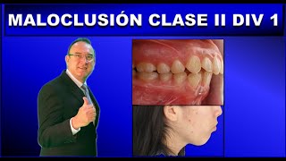 MALOCLUSION CLASE 2 DIVISION 1 DE ANGLE  ORTODONCIA [upl. by Gannie]