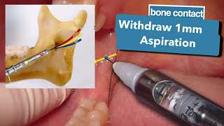 INFERIOR ALVEOLAR NERVE BLOCK أفضل شرح مبسط لطبيب الأسنان [upl. by Pedroza]