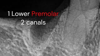 Endodontic treatment Lower premolar 2 canals [upl. by Terryl]