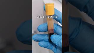 Lipemic serum sample medtech laboratory medtechstudent cls mls lab bloodserum serum lipemia [upl. by Maxine771]