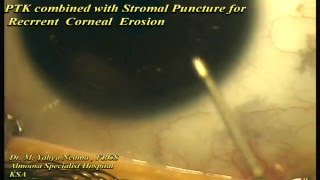 PTK with stromal Puncture for RCE [upl. by Wende]