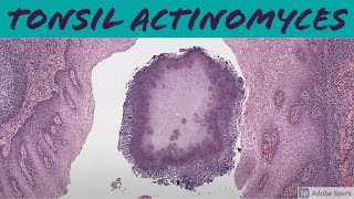 Tonsil Actinomyces 5Minute Pathology Pearls [upl. by Naugal361]