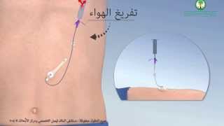 Gastrostomy Feeding Tube أنبوب التغذية ميكي عبر جدار البطن [upl. by Mallon]