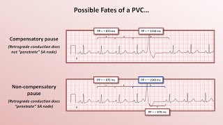 Advanced EKGs  PACs and PVCs ie premature beats [upl. by Farleigh518]