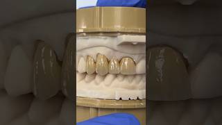 Splinted Zen Enamel and Monet Pure Zirconia EnvisiontecMain envisiontec lsk121shorts teeth [upl. by Tedder]