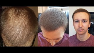 Hair Loss Concealers Dermmatch amp Toppik Hair Fibers Experiment 2020 [upl. by Mori]