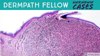 Dermpath Fellow Unknown Cases Filler reaction large Bcell lymphoma radiation dermatitis amp more [upl. by Alym988]