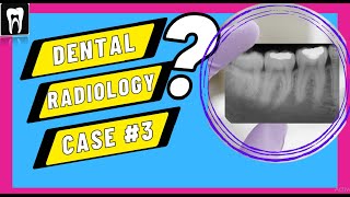 Dental Radiology Case3 Radiographic Interpretation DENTAL CASE DISCUSSION Facial space infection [upl. by Seymour]