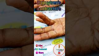 Dupuytrens contracture अंगुलियों की नस का सूखना ll डॉ इरफ़ान सिद्दीक़ी llbest factssciencebone [upl. by Ddet]