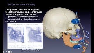 Biomécanique Orthodontique N°3  Masque Facial de Delaire [upl. by Kery]