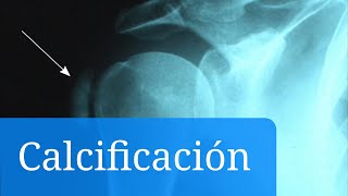 Calcificaciones Cuáles son los síntomas y el tratamiento de las complicaciones [upl. by Frida]