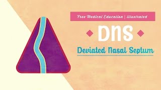 What is Deviated Nasal Septum DNS [upl. by Philander62]