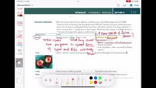 Common metastasis Pathology 42 First Aid USMLE Step 1 in UrduHindi [upl. by Orabel]