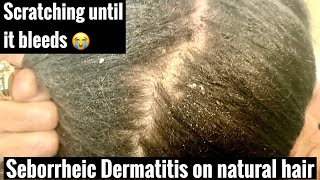 How to treat Seborrheic Dermatitis  Shampoo for DRY FLAKY scalp [upl. by Eissahc653]