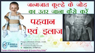 Congenital Hip Dislocation जन्मजात कूल्हे के जोड़ का उतर जाना पहचान एवं इलाज Dr J K Jain [upl. by Nosak]