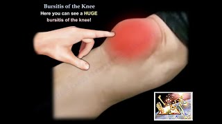 Knee Bursitis  Everything You Need To Know  Dr Nabil Ebraheim [upl. by Atived282]