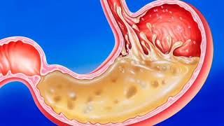 SÍNDROME DE ZOLLINGER ELLISON Agruras reflujo úlcera péptica tumor estomacal  gastrinoma [upl. by Euqinot]