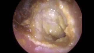 194 Eardrum about to EXPLODE after Blocked Ear Wax Removal using Endoscopic Ear Microsuction [upl. by Janifer920]