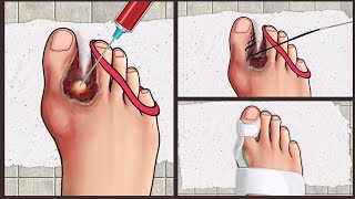 ASMR Treatment Athletes foot and warts between toes at home  Foot care animation [upl. by Graves]