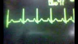 ECG Video Ectopics  Atrial [upl. by Sitelc]