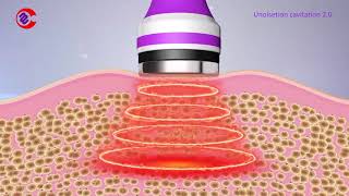 How Ultrasonic Cavitation Work How Ultrasonic Cavitation Remove Fat What Is Cavitation Machine [upl. by Salsbury]