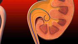 Ureteral Obstruction  Retrograde insertion of Resonance stent [upl. by Lydell]