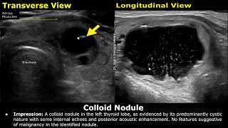 Thyroid Ultrasound Reporting  How To Write USG Scan Reports  Thyroid Pathologies  Small Parts USG [upl. by Yelrehs856]