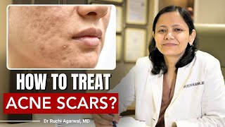 How to treat Acne Scars  Acne Scar Treatment  Acne Scars  Dr Ruchi Agarwal  Satya acnescars [upl. by Forrester]