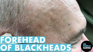 A Forehead of Blackhead Extractions Dr Pimple Popper Mines a Patients Head [upl. by Reivaz]