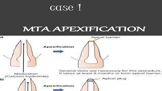 MTA APEXIFICATION case 1 apexification steps [upl. by Nnarefinnej461]