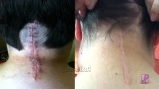 Chiari Malformation 1 Year PostOp [upl. by Codi139]