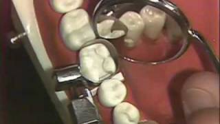 Packing of Class II Amalgam for Hygienists [upl. by Scarito177]